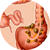 tratamiento para diverticulitis