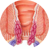 tratamiento para hemorroides